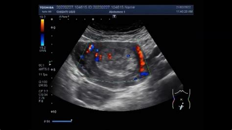 uterine polyp impact blood test|polyp in uterus pain.